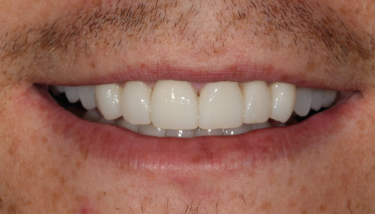 After - Montpelier Dental Care