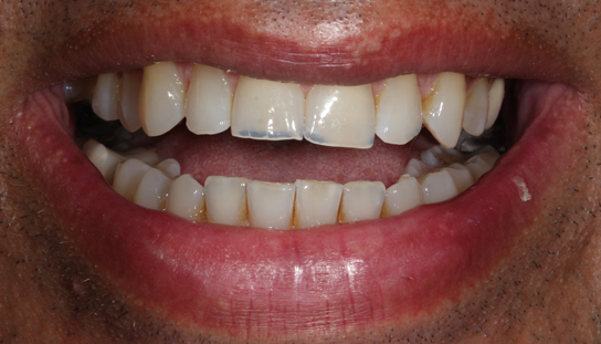 Before - Montpelier Dental Care